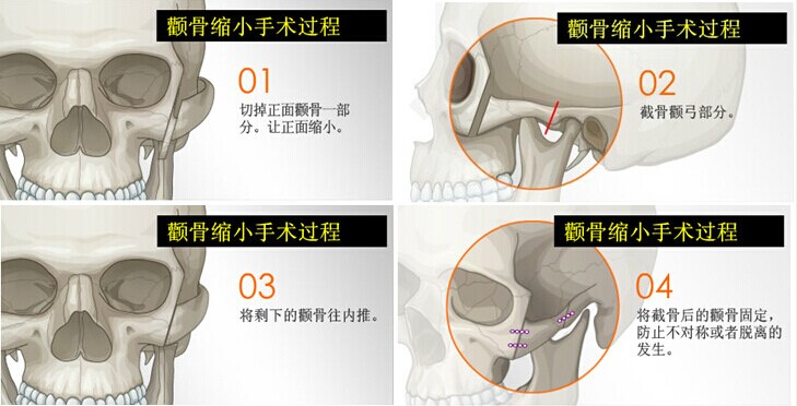 颧骨缩小术