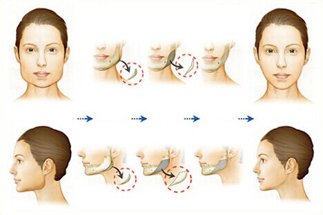 方形脸缩小手术