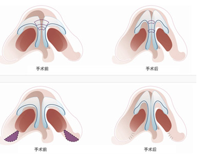 鼻孔大可以缩小吗，巫文云医生做鼻缩小怎么样?