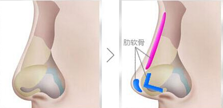 自体软骨鼻尖整形多少钱