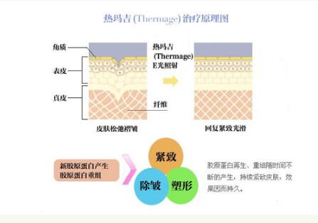 热玛吉需要隔多久做一次?