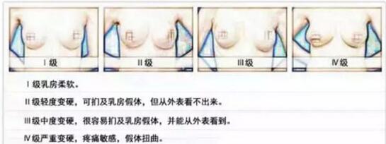 如何降低假体隆胸后包膜挛缩的几率？