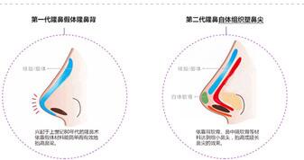 苏州美莱超全鼻整形价格一览表