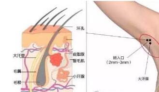 深圳联合丽格王洪军除腋臭以后会复发吗